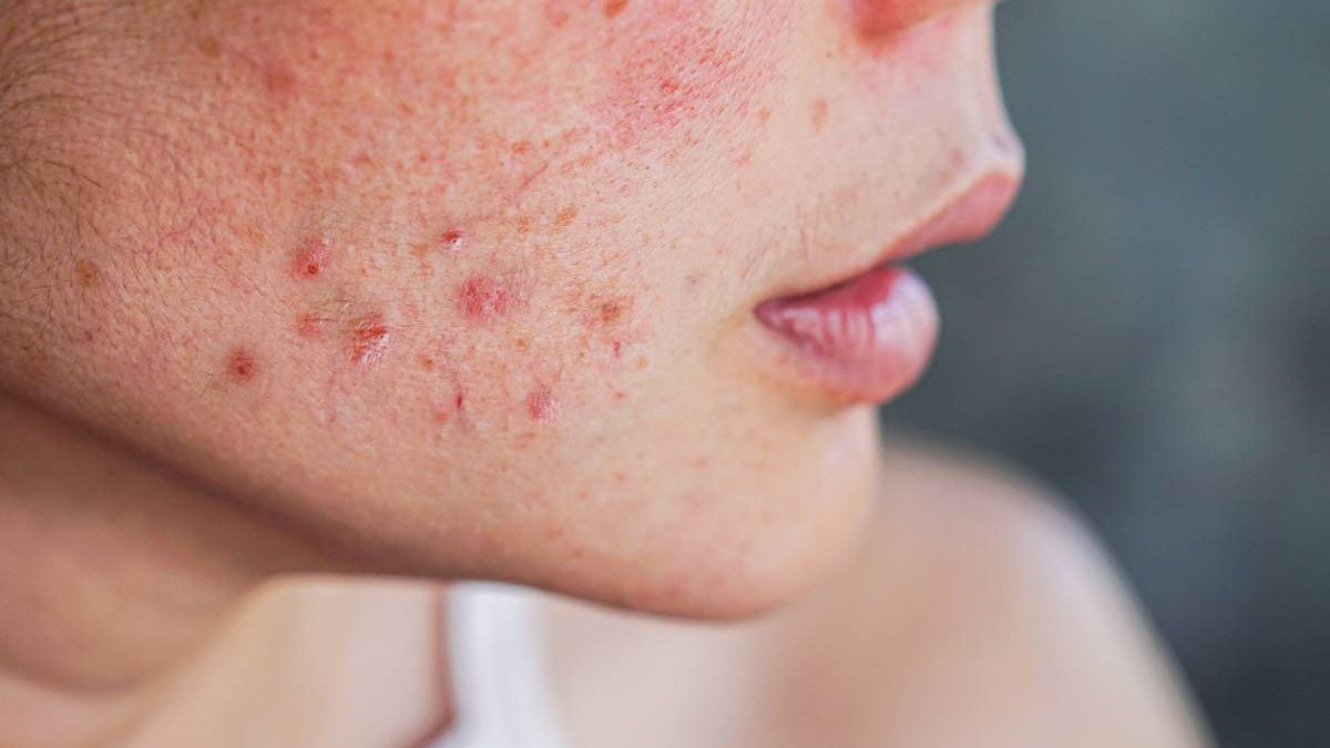 imperfections-appelle-peau-une-qu