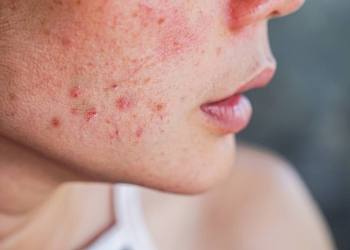 imperfections-appelle-peau-une-qu