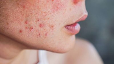 imperfections-appelle-peau-une-qu