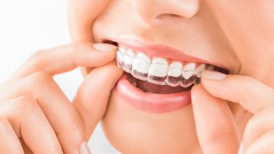 gouttieres transparantes dents