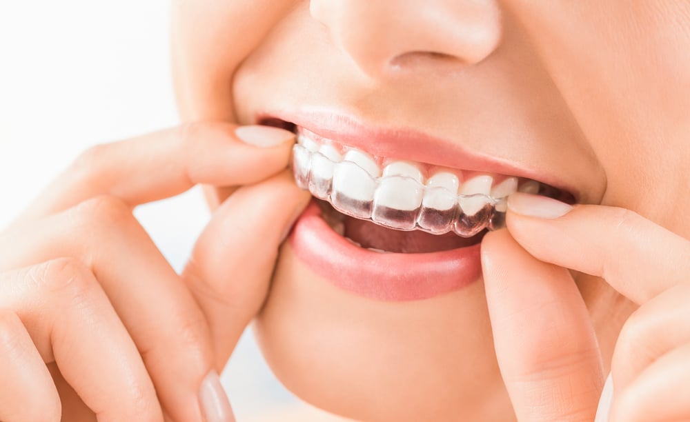 gouttieres transparantes dents