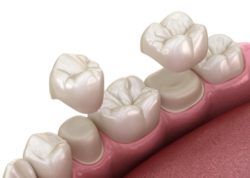 2 couronnes dentaires